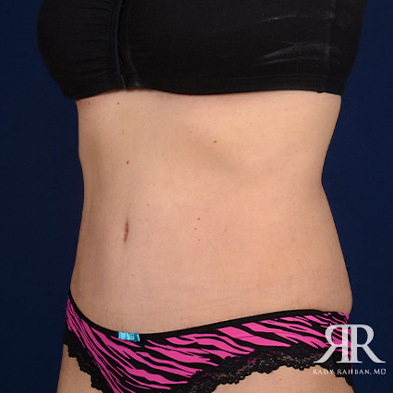 Tummy Tuck Before & After Gallery - Patient 811543 - Image 4