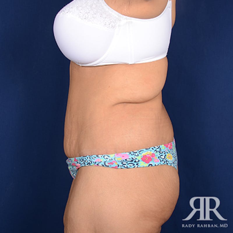 Body Lift Before & After Gallery - Patient 348352 - Image 6