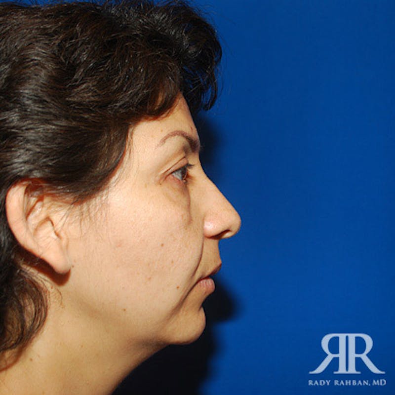 Chin Augmentation Before & After Gallery - Patient 167309 - Image 3