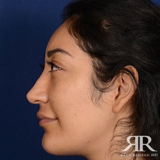 Female Rhinoplasty Before & After Gallery - Patient 123864 - Image 6