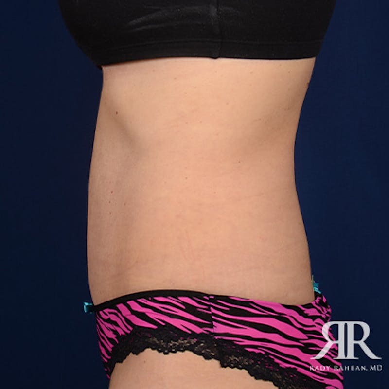 Tummy Tuck Before & After Gallery - Patient 811543 - Image 6