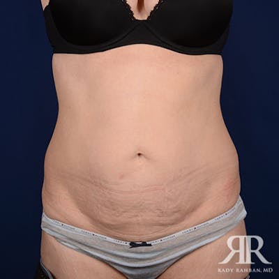 Body Lift Before & After Gallery - Patient 347573 - Image 1