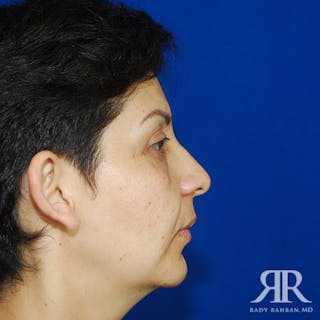 Chin Augmentation Before & After Gallery - Patient 167309 - Image 4