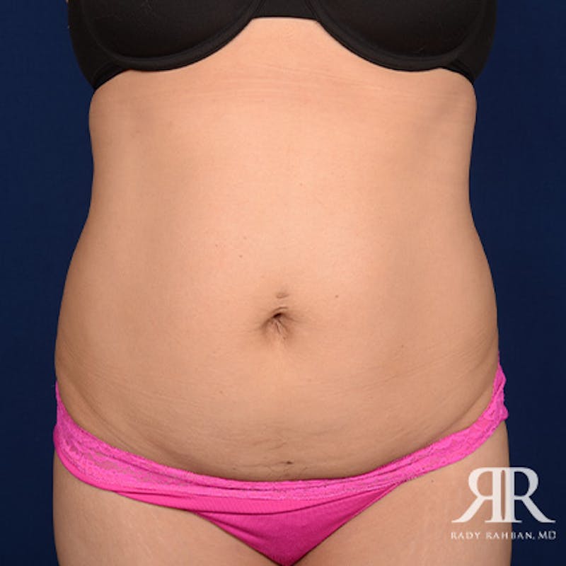 Tummy Tuck Before & After Gallery - Patient 351682 - Image 1