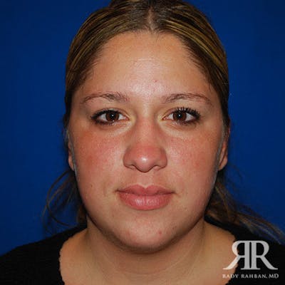 Chin Augmentation Before & After Gallery - Patient 377061 - Image 1