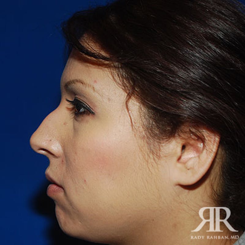 Ethnic Rhinoplasty Before & After Gallery - Patient 336033 - Image 5
