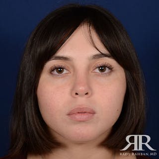 Female Rhinoplasty Before & After Gallery - Patient 128025 - Image 2