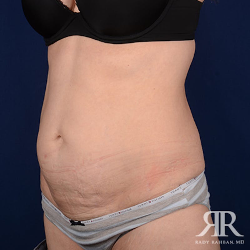 Body Lift Before & After Gallery - Patient 347573 - Image 3