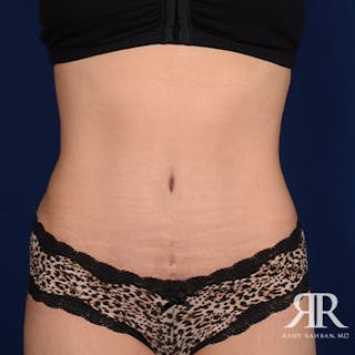Tummy Tuck Before & After Gallery - Patient 351682 - Image 2