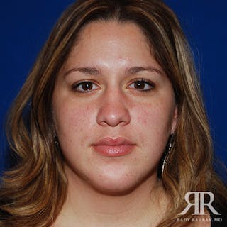 Chin Augmentation Before & After Gallery - Patient 377061 - Image 2