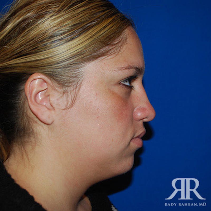 Chin Augmentation Before & After Gallery - Patient 377061 - Image 3