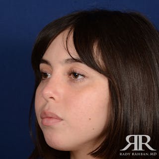 Female Rhinoplasty Before & After Gallery - Patient 128025 - Image 4