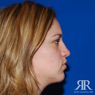 Chin Augmentation Before & After Gallery - Patient 377061 - Image 4