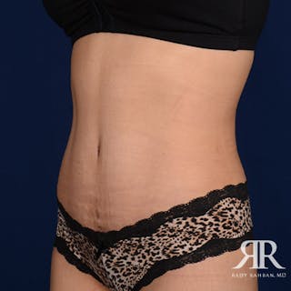 Tummy Tuck Before & After Gallery - Patient 351682 - Image 4