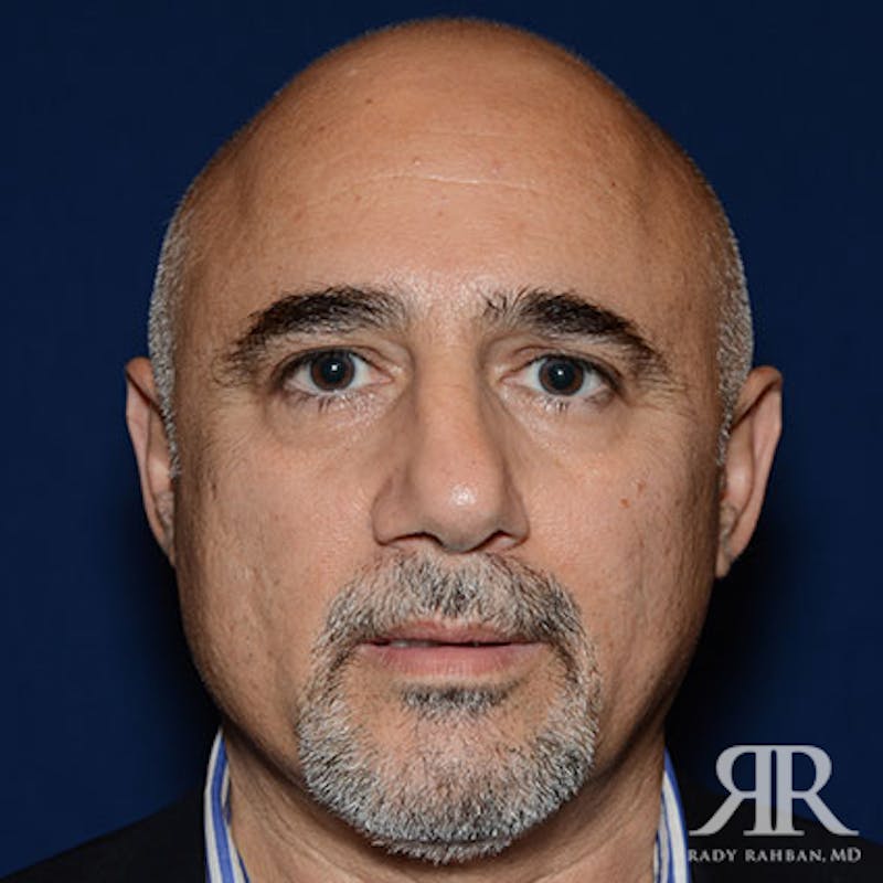 Ethnic Rhinoplasty Before & After Gallery - Patient 778840 - Image 1