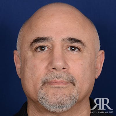 Ethnic Rhinoplasty Before & After Gallery - Patient 778840 - Image 2