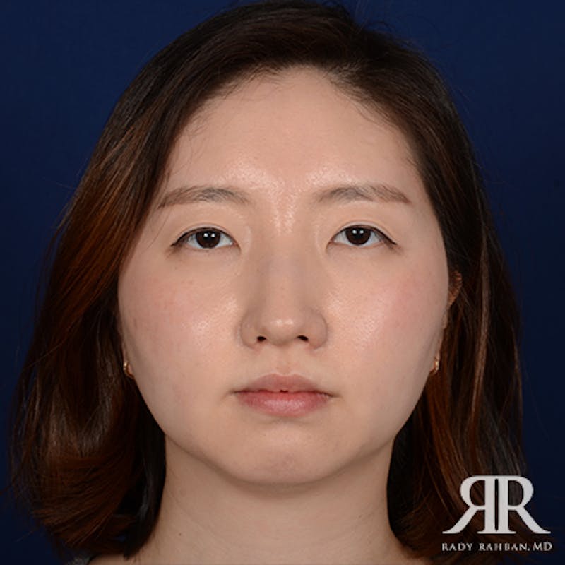Chin Augmentation Before & After Gallery - Patient 327216 - Image 1