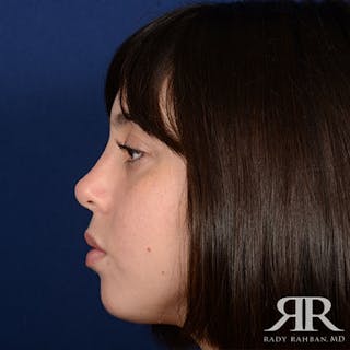 Female Rhinoplasty Before & After Gallery - Patient 128025 - Image 6