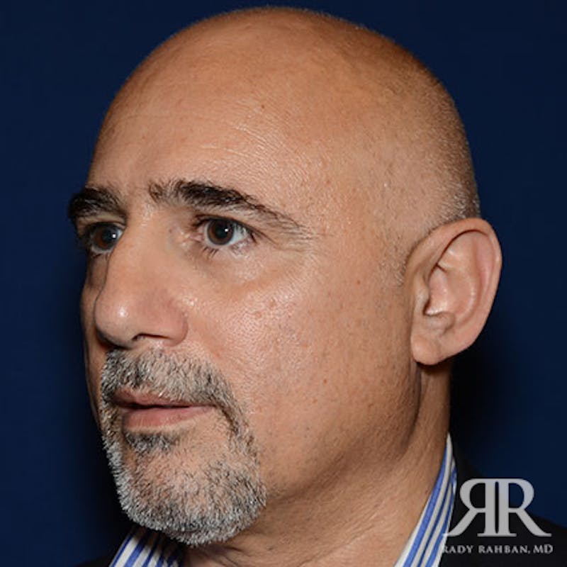 Ethnic Rhinoplasty Before & After Gallery - Patient 778840 - Image 3