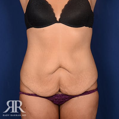Body Lift Before & After Gallery - Patient 331789 - Image 1