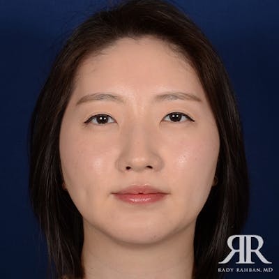 Chin Augmentation Before & After Gallery - Patient 327216 - Image 2