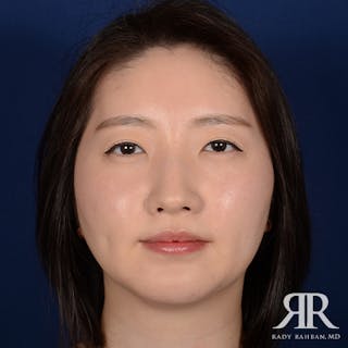 Chin Augmentation Before & After Gallery - Patient 327216 - Image 2