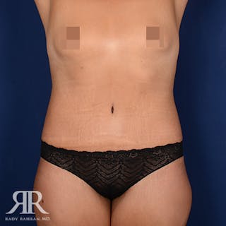 Body Lift Before & After Gallery - Patient 331789 - Image 2