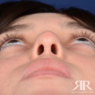 Female Rhinoplasty Before & After Gallery - Patient 128025 - Image 8