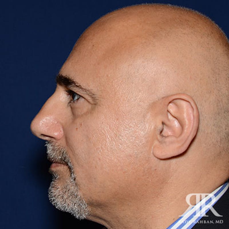 Ethnic Rhinoplasty Before & After Gallery - Patient 778840 - Image 5