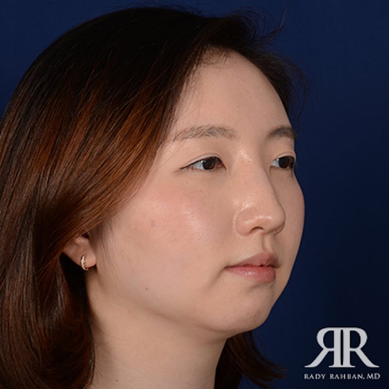 Chin Augmentation Before & After Gallery - Patient 327216 - Image 3