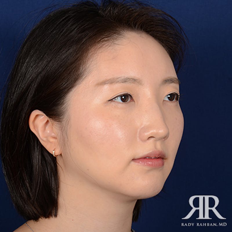 Chin Augmentation Before & After Gallery - Patient 327216 - Image 4