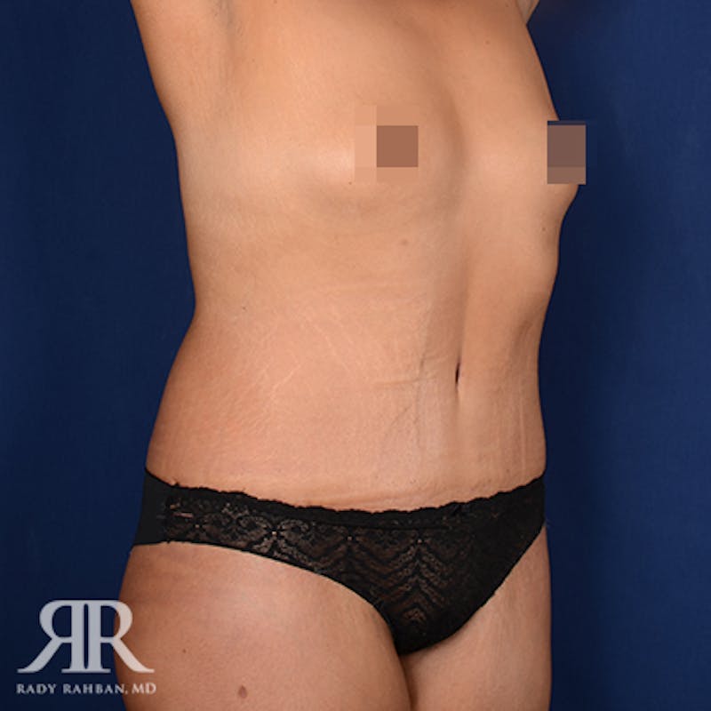 Body Lift Before & After Gallery - Patient 331789 - Image 4