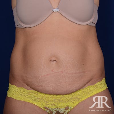 Severe Diastasis Recti Before & After Gallery - Patient 418760 - Image 1