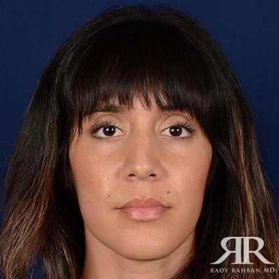 Female Rhinoplasty Before & After Gallery - Patient 167604 - Image 1