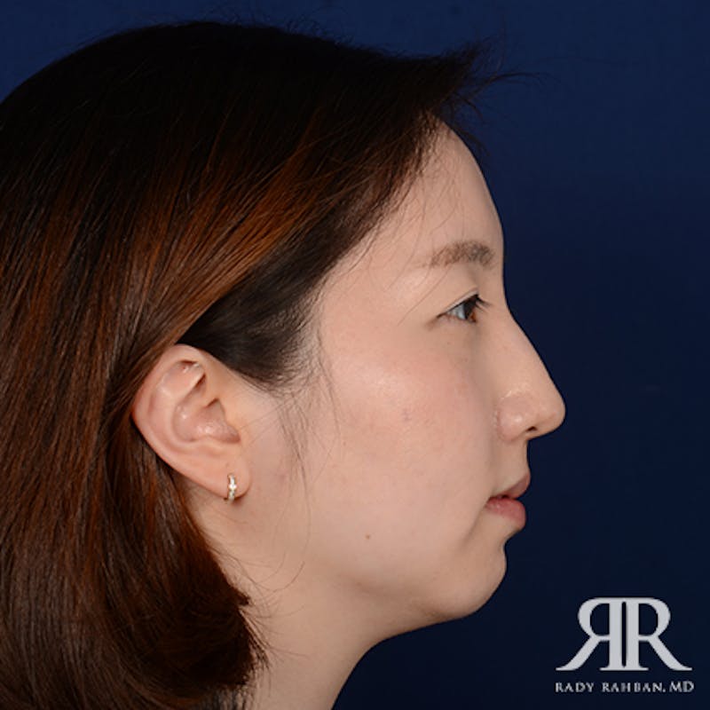 Chin Augmentation Before & After Gallery - Patient 327216 - Image 5