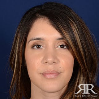 Female Rhinoplasty Before & After Gallery - Patient 167604 - Image 2