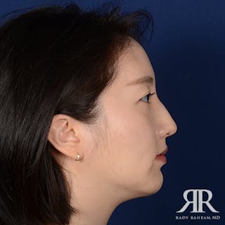 Chin Augmentation Before & After Gallery - Patient 327216 - Image 6