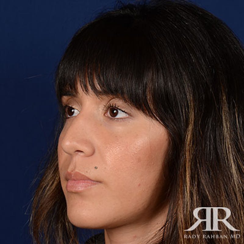 Female Rhinoplasty Before & After Gallery - Patient 167604 - Image 3