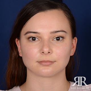 Chin Augmentation Before & After Gallery - Patient 399951 - Image 2