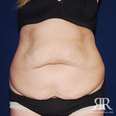 Tummy Tuck Before & After Gallery - Patient 355058 - Image 1