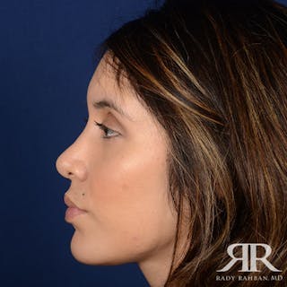 Female Rhinoplasty Before & After Gallery - Patient 167604 - Image 6
