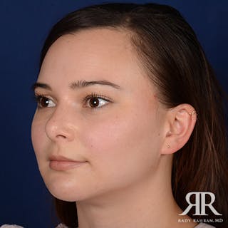 Chin Augmentation Before & After Gallery - Patient 399951 - Image 4