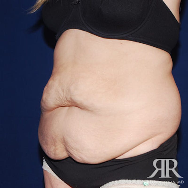 Tummy Tuck Before & After Gallery - Patient 355058 - Image 3
