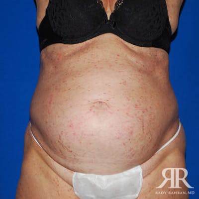 Severe Diastasis Recti Before & After Gallery - Patient 392076 - Image 1