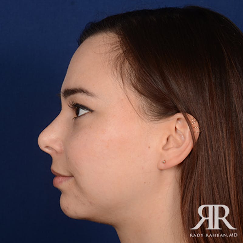 Chin Augmentation Before & After Gallery - Patient 399951 - Image 5