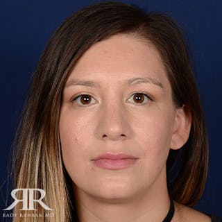 Female Rhinoplasty Before & After Gallery - Patient 378780 - Image 2
