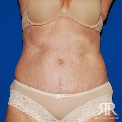 Severe Diastasis Recti Before & After Gallery - Patient 392076 - Image 2