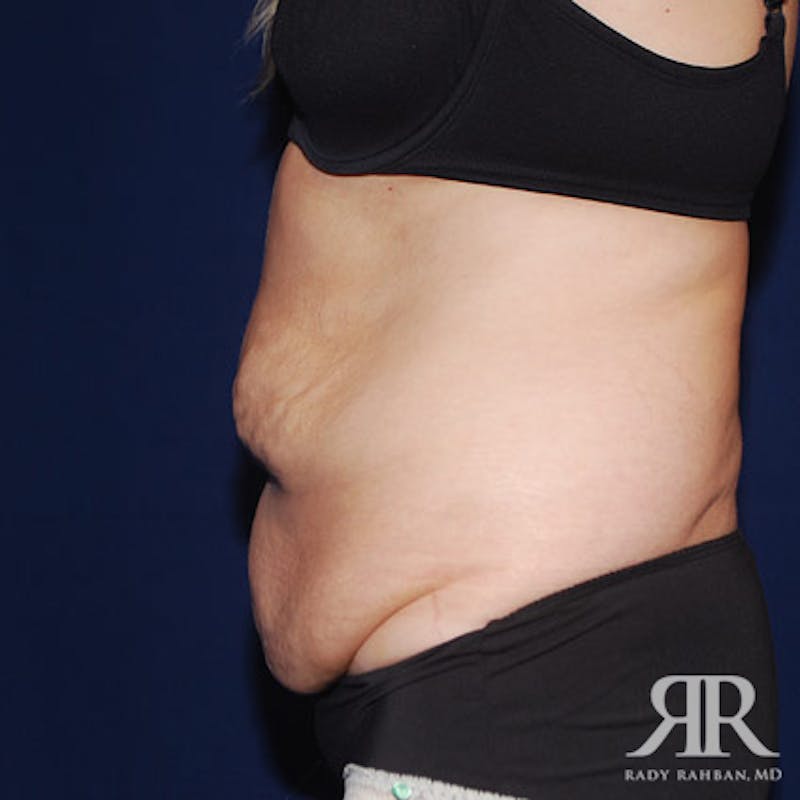 Tummy Tuck Before & After Gallery - Patient 355058 - Image 5