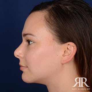 Chin Augmentation Before & After Gallery - Patient 399951 - Image 6