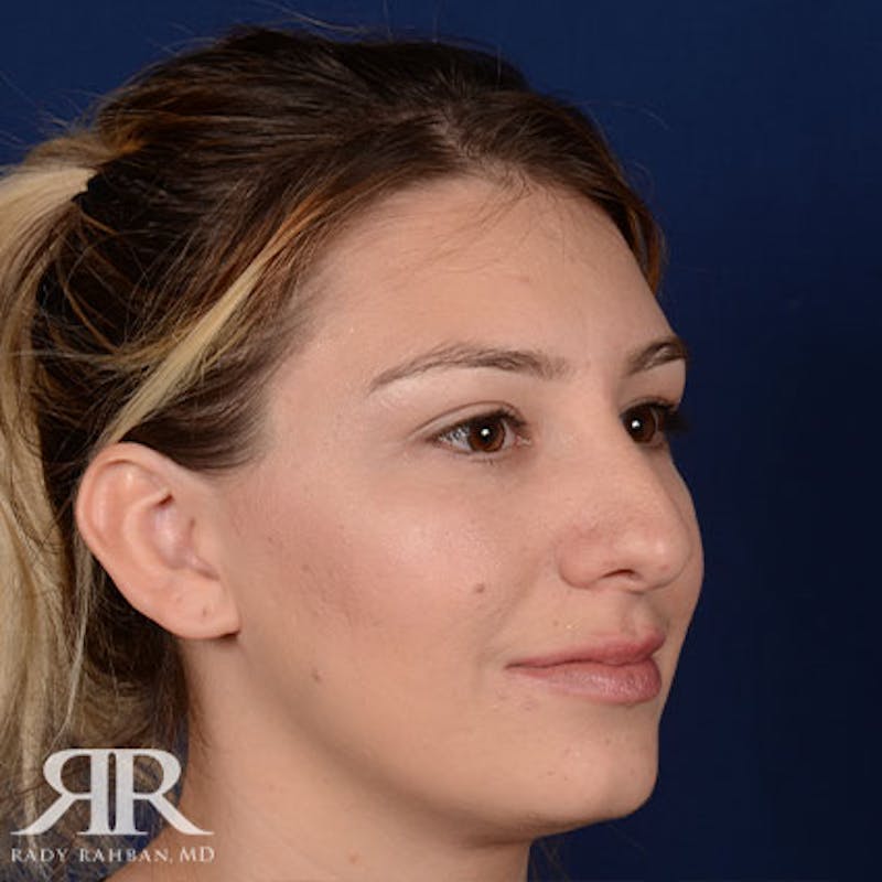 Female Rhinoplasty Before & After Gallery - Patient 378780 - Image 3